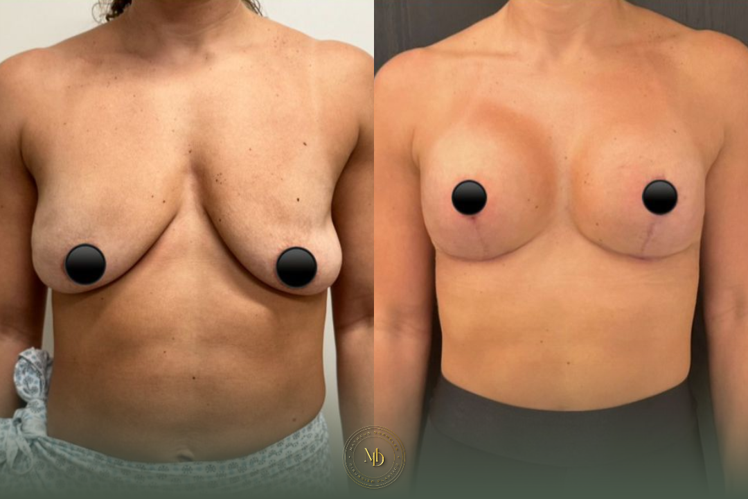 cirurgião plástico na barra da tijuca, cirurgião plástico barra da tijuca, cirurgião plástico rio de janeiro, cirurgião plástico rj, cirurgião plástico zona oeste rj, cirurgião plástico particular rj, cirurgia plástica barra da tijuca, clínica de cirurgia plástica barra da tijuca, cirurgia plástica rio de janeiro, melhor cirurgião plástico da barra, melhores cirurgiões plásticos do rio de janeiro, cirurgião plástico recomendado rj, cirurgião plástico bem avaliado barra da tijuca, cirurgia plástica de alto padrão rj, cirurgião plástico especializado em mamas, cirurgia das mamas rj, prótese de mama barra da tijuca, implante de silicone rj, aumento de mama rio de janeiro, mastopexia rj, mastopexia com prótese barra da tijuca, mastopexia sem prótese rj, lifting de mamas rj, explante de silicone rio de janeiro, retirada de prótese de mama rj, cirurgia de explante barra da tijuca, cirurgia mamária rj, cirurgião de mama rj, cirurgia de contorno corporal rj, lipoaspiração barra da tijuca, lipoaspiração rj, lipoescultura rio de janeiro, abdominoplastia rj, cirurgia abdominal estética rj, contorno corporal barra da tijuca, cirurgia plástica feminina rj, cirurgia plástica estética rj, cirurgia plástica particular barra da tijuca, cirurgião plástico de confiança rj, cirurgião plástico experiente rio de janeiro, dr matheus dorneles, dr matheus dorneles cirurgião plástico, clínica dr matheus dorneles, consultório de cirurgia plástica barra da tijuca, cirurgia plástica avenida das américas, cirurgião plástico avenida das américas, cirurgia plástica recreio dos bandeirantes, cirurgia plástica zona sul rj, cirurgia plástica leblon, cirurgia plástica barra premium.