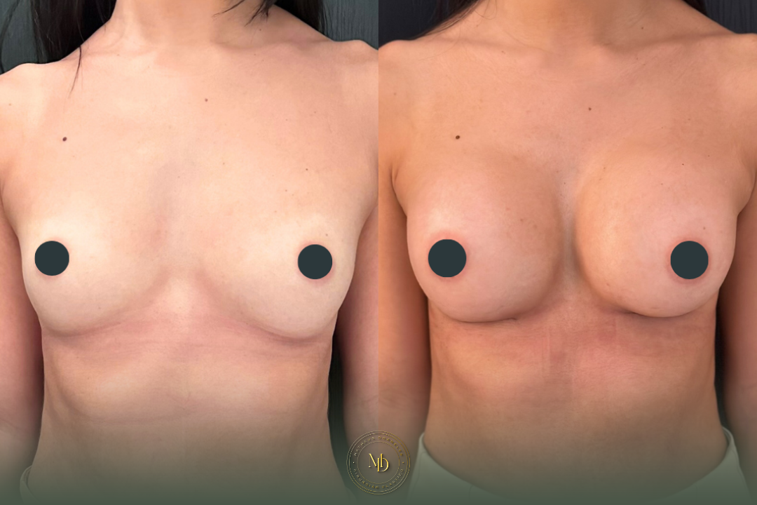 cirurgião plástico na barra da tijuca, cirurgião plástico barra da tijuca, cirurgião plástico rio de janeiro, cirurgião plástico rj, cirurgião plástico zona oeste rj, cirurgião plástico particular rj, cirurgia plástica barra da tijuca, clínica de cirurgia plástica barra da tijuca, cirurgia plástica rio de janeiro, melhor cirurgião plástico da barra, melhores cirurgiões plásticos do rio de janeiro, cirurgião plástico recomendado rj, cirurgião plástico bem avaliado barra da tijuca, cirurgia plástica de alto padrão rj, cirurgião plástico especializado em mamas, cirurgia das mamas rj, prótese de mama barra da tijuca, implante de silicone rj, aumento de mama rio de janeiro, mastopexia rj, mastopexia com prótese barra da tijuca, mastopexia sem prótese rj, lifting de mamas rj, explante de silicone rio de janeiro, retirada de prótese de mama rj, cirurgia de explante barra da tijuca, cirurgia mamária rj, cirurgião de mama rj, cirurgia de contorno corporal rj, lipoaspiração barra da tijuca, lipoaspiração rj, lipoescultura rio de janeiro, abdominoplastia rj, cirurgia abdominal estética rj, contorno corporal barra da tijuca, cirurgia plástica feminina rj, cirurgia plástica estética rj, cirurgia plástica particular barra da tijuca, cirurgião plástico de confiança rj, cirurgião plástico experiente rio de janeiro, dr matheus dorneles, dr matheus dorneles cirurgião plástico, clínica dr matheus dorneles, consultório de cirurgia plástica barra da tijuca, cirurgia plástica avenida das américas, cirurgião plástico avenida das américas, cirurgia plástica recreio dos bandeirantes, cirurgia plástica zona sul rj, cirurgia plástica leblon, cirurgia plástica barra premium.