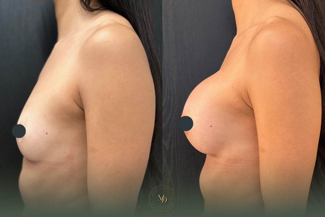 cirurgião plástico na barra da tijuca, cirurgião plástico barra da tijuca, cirurgião plástico rio de janeiro, cirurgião plástico rj, cirurgião plástico zona oeste rj, cirurgião plástico particular rj, cirurgia plástica barra da tijuca, clínica de cirurgia plástica barra da tijuca, cirurgia plástica rio de janeiro, melhor cirurgião plástico da barra, melhores cirurgiões plásticos do rio de janeiro, cirurgião plástico recomendado rj, cirurgião plástico bem avaliado barra da tijuca, cirurgia plástica de alto padrão rj, cirurgião plástico especializado em mamas, cirurgia das mamas rj, prótese de mama barra da tijuca, implante de silicone rj, aumento de mama rio de janeiro, mastopexia rj, mastopexia com prótese barra da tijuca, mastopexia sem prótese rj, lifting de mamas rj, explante de silicone rio de janeiro, retirada de prótese de mama rj, cirurgia de explante barra da tijuca, cirurgia mamária rj, cirurgião de mama rj, cirurgia de contorno corporal rj, lipoaspiração barra da tijuca, lipoaspiração rj, lipoescultura rio de janeiro, abdominoplastia rj, cirurgia abdominal estética rj, contorno corporal barra da tijuca, cirurgia plástica feminina rj, cirurgia plástica estética rj, cirurgia plástica particular barra da tijuca, cirurgião plástico de confiança rj, cirurgião plástico experiente rio de janeiro, dr matheus dorneles, dr matheus dorneles cirurgião plástico, clínica dr matheus dorneles, consultório de cirurgia plástica barra da tijuca, cirurgia plástica avenida das américas, cirurgião plástico avenida das américas, cirurgia plástica recreio dos bandeirantes, cirurgia plástica zona sul rj, cirurgia plástica leblon, cirurgia plástica barra premium.