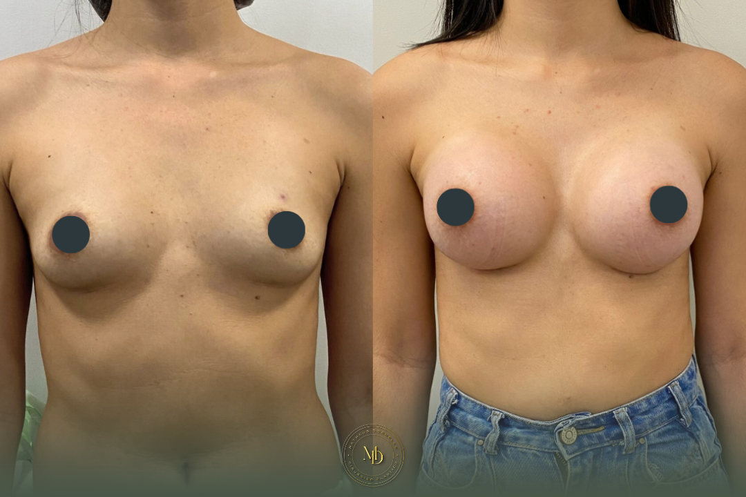 cirurgião plástico na barra da tijuca, cirurgião plástico barra da tijuca, cirurgião plástico rio de janeiro, cirurgião plástico rj, cirurgião plástico zona oeste rj, cirurgião plástico particular rj, cirurgia plástica barra da tijuca, clínica de cirurgia plástica barra da tijuca, cirurgia plástica rio de janeiro, melhor cirurgião plástico da barra, melhores cirurgiões plásticos do rio de janeiro, cirurgião plástico recomendado rj, cirurgião plástico bem avaliado barra da tijuca, cirurgia plástica de alto padrão rj, cirurgião plástico especializado em mamas, cirurgia das mamas rj, prótese de mama barra da tijuca, implante de silicone rj, aumento de mama rio de janeiro, mastopexia rj, mastopexia com prótese barra da tijuca, mastopexia sem prótese rj, lifting de mamas rj, explante de silicone rio de janeiro, retirada de prótese de mama rj, cirurgia de explante barra da tijuca, cirurgia mamária rj, cirurgião de mama rj, cirurgia de contorno corporal rj, lipoaspiração barra da tijuca, lipoaspiração rj, lipoescultura rio de janeiro, abdominoplastia rj, cirurgia abdominal estética rj, contorno corporal barra da tijuca, cirurgia plástica feminina rj, cirurgia plástica estética rj, cirurgia plástica particular barra da tijuca, cirurgião plástico de confiança rj, cirurgião plástico experiente rio de janeiro, dr matheus dorneles, dr matheus dorneles cirurgião plástico, clínica dr matheus dorneles, consultório de cirurgia plástica barra da tijuca, cirurgia plástica avenida das américas, cirurgião plástico avenida das américas, cirurgia plástica recreio dos bandeirantes, cirurgia plástica zona sul rj, cirurgia plástica leblon, cirurgia plástica barra premium.