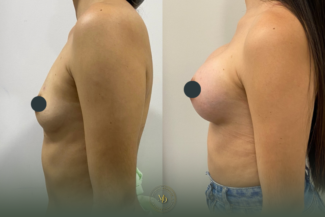 cirurgião plástico na barra da tijuca, cirurgião plástico barra da tijuca, cirurgião plástico rio de janeiro, cirurgião plástico rj, cirurgião plástico zona oeste rj, cirurgião plástico particular rj, cirurgia plástica barra da tijuca, clínica de cirurgia plástica barra da tijuca, cirurgia plástica rio de janeiro, melhor cirurgião plástico da barra, melhores cirurgiões plásticos do rio de janeiro, cirurgião plástico recomendado rj, cirurgião plástico bem avaliado barra da tijuca, cirurgia plástica de alto padrão rj, cirurgião plástico especializado em mamas, cirurgia das mamas rj, prótese de mama barra da tijuca, implante de silicone rj, aumento de mama rio de janeiro, mastopexia rj, mastopexia com prótese barra da tijuca, mastopexia sem prótese rj, lifting de mamas rj, explante de silicone rio de janeiro, retirada de prótese de mama rj, cirurgia de explante barra da tijuca, cirurgia mamária rj, cirurgião de mama rj, cirurgia de contorno corporal rj, lipoaspiração barra da tijuca, lipoaspiração rj, lipoescultura rio de janeiro, abdominoplastia rj, cirurgia abdominal estética rj, contorno corporal barra da tijuca, cirurgia plástica feminina rj, cirurgia plástica estética rj, cirurgia plástica particular barra da tijuca, cirurgião plástico de confiança rj, cirurgião plástico experiente rio de janeiro, dr matheus dorneles, dr matheus dorneles cirurgião plástico, clínica dr matheus dorneles, consultório de cirurgia plástica barra da tijuca, cirurgia plástica avenida das américas, cirurgião plástico avenida das américas, cirurgia plástica recreio dos bandeirantes, cirurgia plástica zona sul rj, cirurgia plástica leblon, cirurgia plástica barra premium.