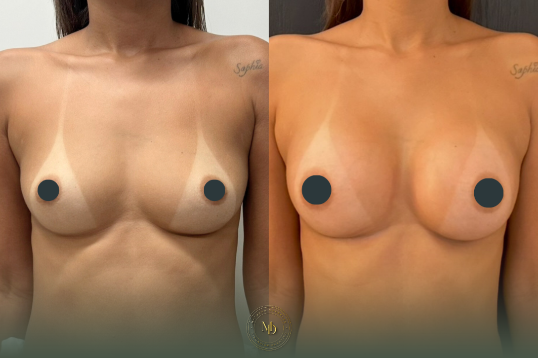 cirurgião plástico na barra da tijuca, cirurgião plástico barra da tijuca, cirurgião plástico rio de janeiro, cirurgião plástico rj, cirurgião plástico zona oeste rj, cirurgião plástico particular rj, cirurgia plástica barra da tijuca, clínica de cirurgia plástica barra da tijuca, cirurgia plástica rio de janeiro, melhor cirurgião plástico da barra, melhores cirurgiões plásticos do rio de janeiro, cirurgião plástico recomendado rj, cirurgião plástico bem avaliado barra da tijuca, cirurgia plástica de alto padrão rj, cirurgião plástico especializado em mamas, cirurgia das mamas rj, prótese de mama barra da tijuca, implante de silicone rj, aumento de mama rio de janeiro, mastopexia rj, mastopexia com prótese barra da tijuca, mastopexia sem prótese rj, lifting de mamas rj, explante de silicone rio de janeiro, retirada de prótese de mama rj, cirurgia de explante barra da tijuca, cirurgia mamária rj, cirurgião de mama rj, cirurgia de contorno corporal rj, lipoaspiração barra da tijuca, lipoaspiração rj, lipoescultura rio de janeiro, abdominoplastia rj, cirurgia abdominal estética rj, contorno corporal barra da tijuca, cirurgia plástica feminina rj, cirurgia plástica estética rj, cirurgia plástica particular barra da tijuca, cirurgião plástico de confiança rj, cirurgião plástico experiente rio de janeiro, dr matheus dorneles, dr matheus dorneles cirurgião plástico, clínica dr matheus dorneles, consultório de cirurgia plástica barra da tijuca, cirurgia plástica avenida das américas, cirurgião plástico avenida das américas, cirurgia plástica recreio dos bandeirantes, cirurgia plástica zona sul rj, cirurgia plástica leblon, cirurgia plástica barra premium.