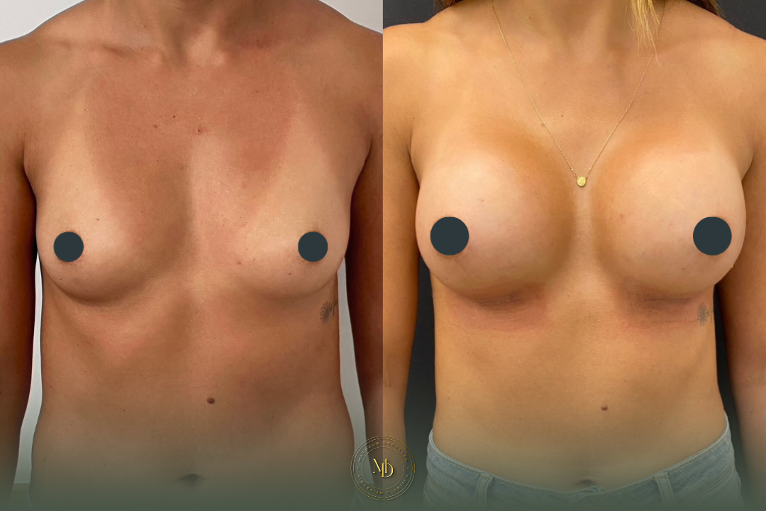 cirurgião plástico na barra da tijuca, cirurgião plástico barra da tijuca, cirurgião plástico rio de janeiro, cirurgião plástico rj, cirurgião plástico zona oeste rj, cirurgião plástico particular rj, cirurgia plástica barra da tijuca, clínica de cirurgia plástica barra da tijuca, cirurgia plástica rio de janeiro, melhor cirurgião plástico da barra, melhores cirurgiões plásticos do rio de janeiro, cirurgião plástico recomendado rj, cirurgião plástico bem avaliado barra da tijuca, cirurgia plástica de alto padrão rj, cirurgião plástico especializado em mamas, cirurgia das mamas rj, prótese de mama barra da tijuca, implante de silicone rj, aumento de mama rio de janeiro, mastopexia rj, mastopexia com prótese barra da tijuca, mastopexia sem prótese rj, lifting de mamas rj, explante de silicone rio de janeiro, retirada de prótese de mama rj, cirurgia de explante barra da tijuca, cirurgia mamária rj, cirurgião de mama rj, cirurgia de contorno corporal rj, lipoaspiração barra da tijuca, lipoaspiração rj, lipoescultura rio de janeiro, abdominoplastia rj, cirurgia abdominal estética rj, contorno corporal barra da tijuca, cirurgia plástica feminina rj, cirurgia plástica estética rj, cirurgia plástica particular barra da tijuca, cirurgião plástico de confiança rj, cirurgião plástico experiente rio de janeiro, dr matheus dorneles, dr matheus dorneles cirurgião plástico, clínica dr matheus dorneles, consultório de cirurgia plástica barra da tijuca, cirurgia plástica avenida das américas, cirurgião plástico avenida das américas, cirurgia plástica recreio dos bandeirantes, cirurgia plástica zona sul rj, cirurgia plástica leblon, cirurgia plástica barra premium.