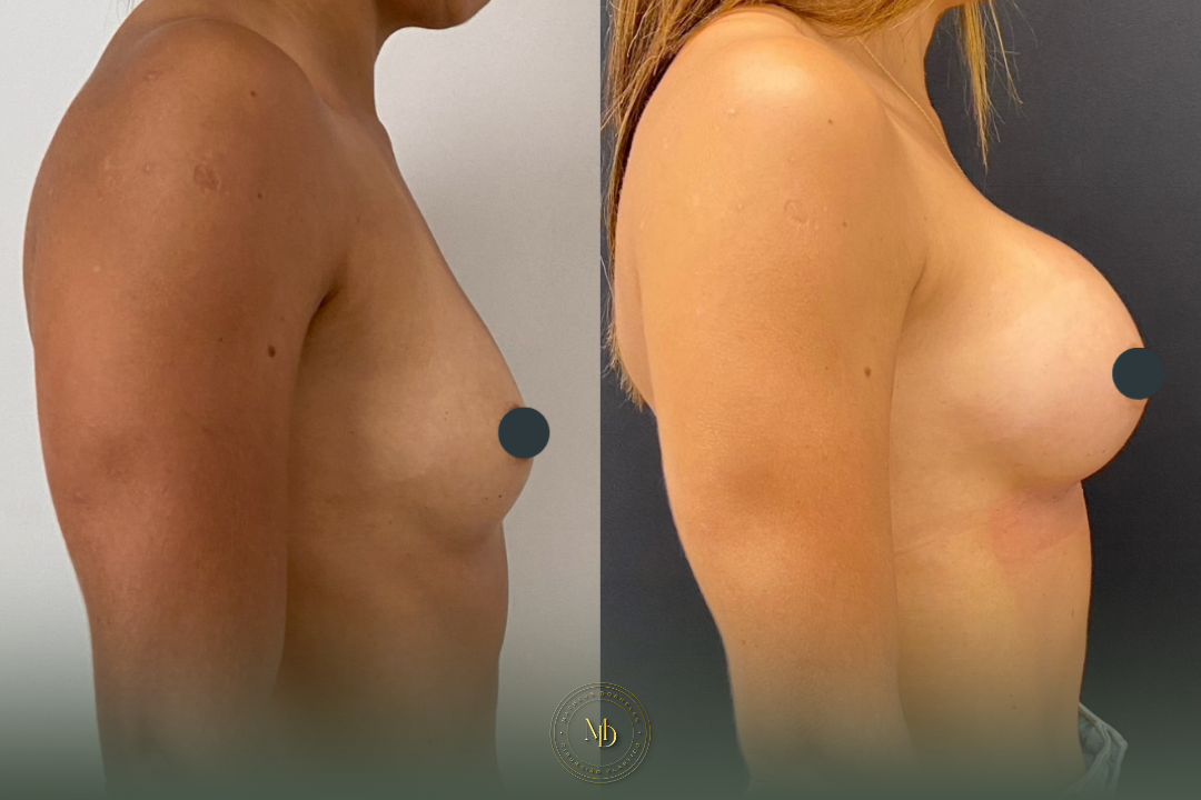 cirurgião plástico na barra da tijuca, cirurgião plástico barra da tijuca, cirurgião plástico rio de janeiro, cirurgião plástico rj, cirurgião plástico zona oeste rj, cirurgião plástico particular rj, cirurgia plástica barra da tijuca, clínica de cirurgia plástica barra da tijuca, cirurgia plástica rio de janeiro, melhor cirurgião plástico da barra, melhores cirurgiões plásticos do rio de janeiro, cirurgião plástico recomendado rj, cirurgião plástico bem avaliado barra da tijuca, cirurgia plástica de alto padrão rj, cirurgião plástico especializado em mamas, cirurgia das mamas rj, prótese de mama barra da tijuca, implante de silicone rj, aumento de mama rio de janeiro, mastopexia rj, mastopexia com prótese barra da tijuca, mastopexia sem prótese rj, lifting de mamas rj, explante de silicone rio de janeiro, retirada de prótese de mama rj, cirurgia de explante barra da tijuca, cirurgia mamária rj, cirurgião de mama rj, cirurgia de contorno corporal rj, lipoaspiração barra da tijuca, lipoaspiração rj, lipoescultura rio de janeiro, abdominoplastia rj, cirurgia abdominal estética rj, contorno corporal barra da tijuca, cirurgia plástica feminina rj, cirurgia plástica estética rj, cirurgia plástica particular barra da tijuca, cirurgião plástico de confiança rj, cirurgião plástico experiente rio de janeiro, dr matheus dorneles, dr matheus dorneles cirurgião plástico, clínica dr matheus dorneles, consultório de cirurgia plástica barra da tijuca, cirurgia plástica avenida das américas, cirurgião plástico avenida das américas, cirurgia plástica recreio dos bandeirantes, cirurgia plástica zona sul rj, cirurgia plástica leblon, cirurgia plástica barra premium.