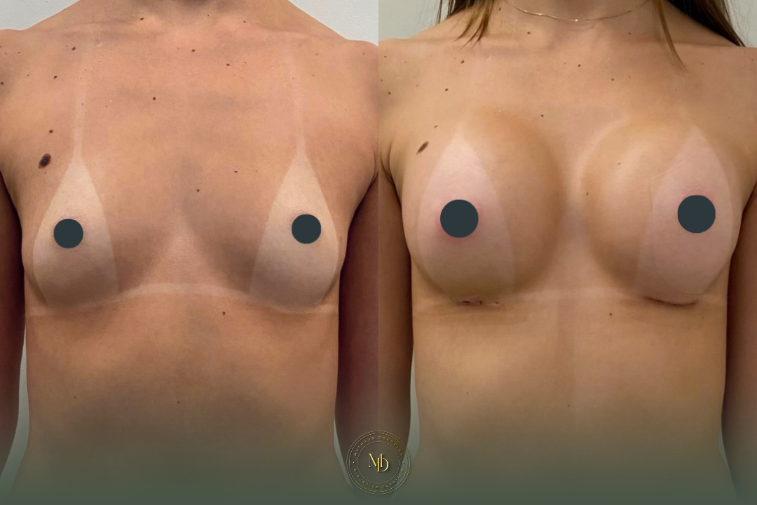 cirurgião plástico na barra da tijuca, cirurgião plástico barra da tijuca, cirurgião plástico rio de janeiro, cirurgião plástico rj, cirurgião plástico zona oeste rj, cirurgião plástico particular rj, cirurgia plástica barra da tijuca, clínica de cirurgia plástica barra da tijuca, cirurgia plástica rio de janeiro, melhor cirurgião plástico da barra, melhores cirurgiões plásticos do rio de janeiro, cirurgião plástico recomendado rj, cirurgião plástico bem avaliado barra da tijuca, cirurgia plástica de alto padrão rj, cirurgião plástico especializado em mamas, cirurgia das mamas rj, prótese de mama barra da tijuca, implante de silicone rj, aumento de mama rio de janeiro, mastopexia rj, mastopexia com prótese barra da tijuca, mastopexia sem prótese rj, lifting de mamas rj, explante de silicone rio de janeiro, retirada de prótese de mama rj, cirurgia de explante barra da tijuca, cirurgia mamária rj, cirurgião de mama rj, cirurgia de contorno corporal rj, lipoaspiração barra da tijuca, lipoaspiração rj, lipoescultura rio de janeiro, abdominoplastia rj, cirurgia abdominal estética rj, contorno corporal barra da tijuca, cirurgia plástica feminina rj, cirurgia plástica estética rj, cirurgia plástica particular barra da tijuca, cirurgião plástico de confiança rj, cirurgião plástico experiente rio de janeiro, dr matheus dorneles, dr matheus dorneles cirurgião plástico, clínica dr matheus dorneles, consultório de cirurgia plástica barra da tijuca, cirurgia plástica avenida das américas, cirurgião plástico avenida das américas, cirurgia plástica recreio dos bandeirantes, cirurgia plástica zona sul rj, cirurgia plástica leblon, cirurgia plástica barra premium.