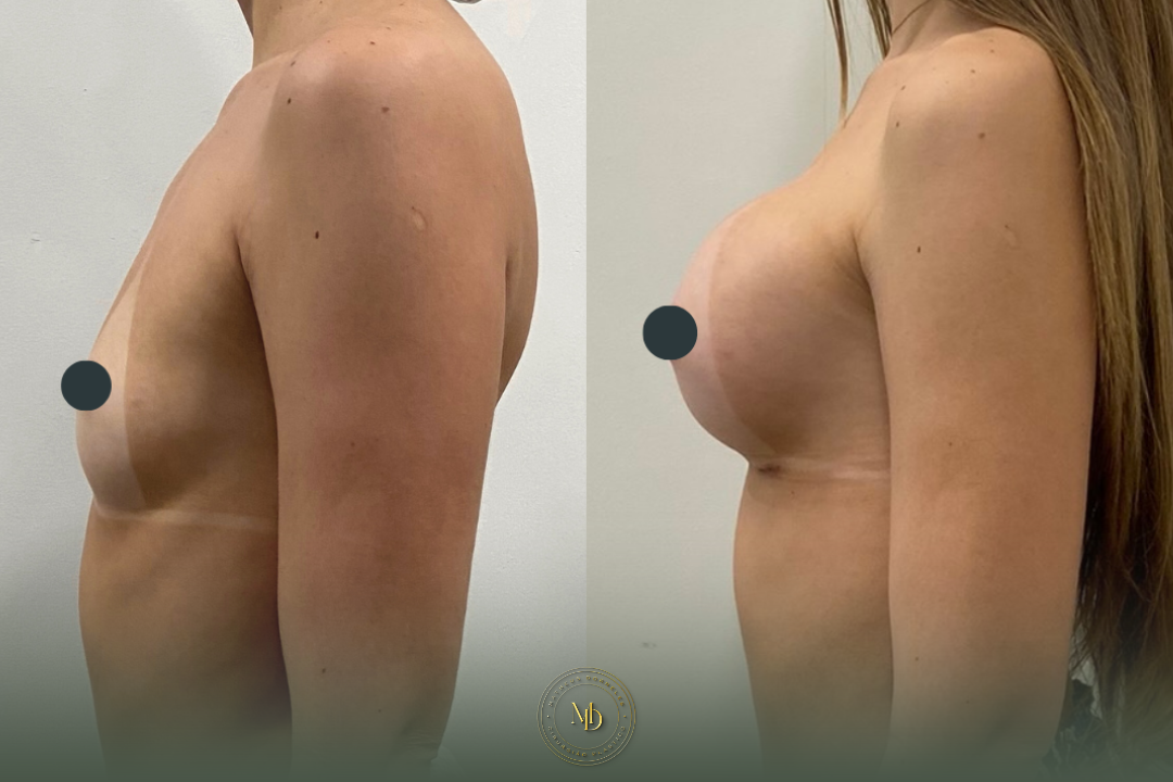 cirurgião plástico na barra da tijuca, cirurgião plástico barra da tijuca, cirurgião plástico rio de janeiro, cirurgião plástico rj, cirurgião plástico zona oeste rj, cirurgião plástico particular rj, cirurgia plástica barra da tijuca, clínica de cirurgia plástica barra da tijuca, cirurgia plástica rio de janeiro, melhor cirurgião plástico da barra, melhores cirurgiões plásticos do rio de janeiro, cirurgião plástico recomendado rj, cirurgião plástico bem avaliado barra da tijuca, cirurgia plástica de alto padrão rj, cirurgião plástico especializado em mamas, cirurgia das mamas rj, prótese de mama barra da tijuca, implante de silicone rj, aumento de mama rio de janeiro, mastopexia rj, mastopexia com prótese barra da tijuca, mastopexia sem prótese rj, lifting de mamas rj, explante de silicone rio de janeiro, retirada de prótese de mama rj, cirurgia de explante barra da tijuca, cirurgia mamária rj, cirurgião de mama rj, cirurgia de contorno corporal rj, lipoaspiração barra da tijuca, lipoaspiração rj, lipoescultura rio de janeiro, abdominoplastia rj, cirurgia abdominal estética rj, contorno corporal barra da tijuca, cirurgia plástica feminina rj, cirurgia plástica estética rj, cirurgia plástica particular barra da tijuca, cirurgião plástico de confiança rj, cirurgião plástico experiente rio de janeiro, dr matheus dorneles, dr matheus dorneles cirurgião plástico, clínica dr matheus dorneles, consultório de cirurgia plástica barra da tijuca, cirurgia plástica avenida das américas, cirurgião plástico avenida das américas, cirurgia plástica recreio dos bandeirantes, cirurgia plástica zona sul rj, cirurgia plástica leblon, cirurgia plástica barra premium.